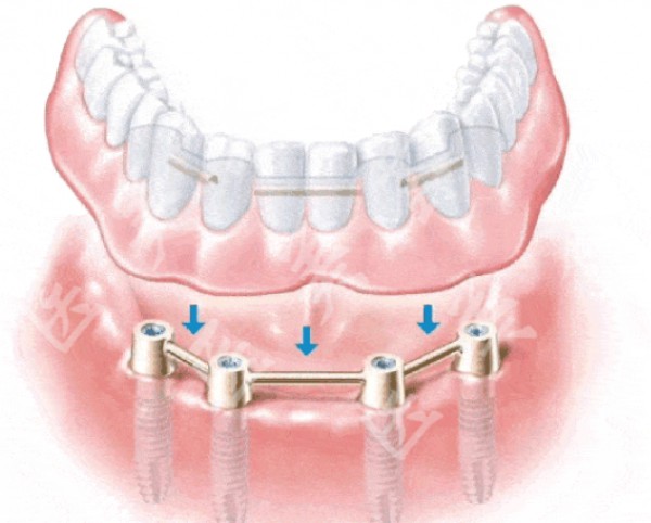 attachments-2020-03-aFJJQ1X45e662f930a037.png