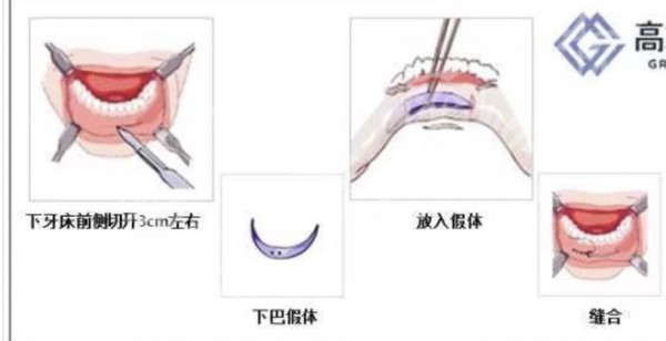 假体下巴切口图片